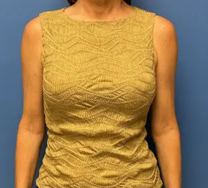 Breast Reconstruction Before and After Patient Thumbnail 3