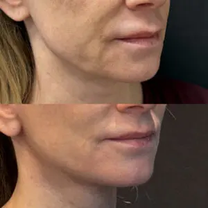 Facelift & Neck Lift Before and After Patient Thumbnail 3