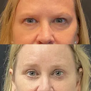 Eyelid Lift Before and After Patient Thumbnail 1