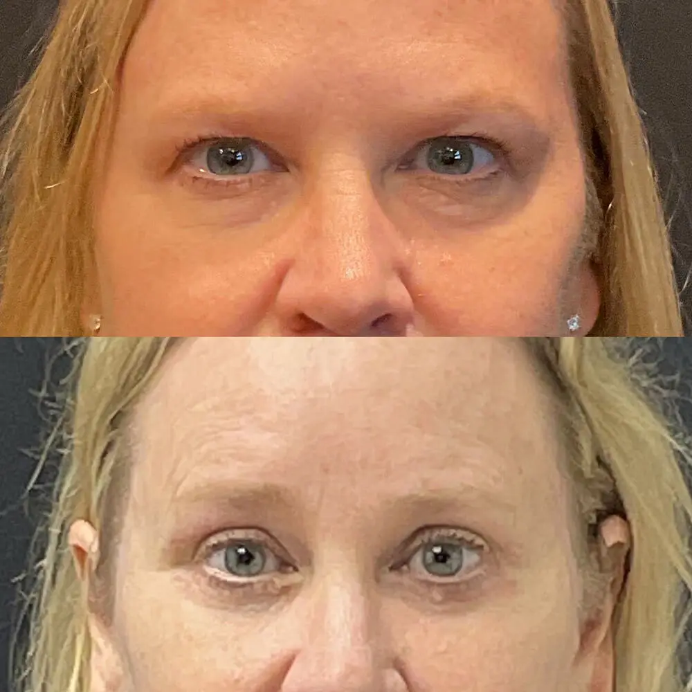 Eyelid Lift Before and After Patient 1