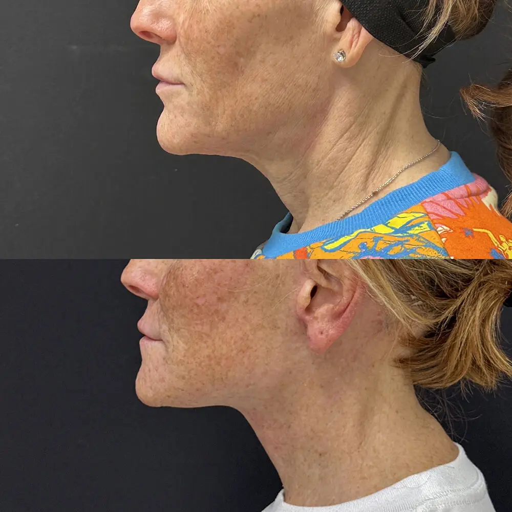 Facelift & Neck Lift Before and After Patient 3