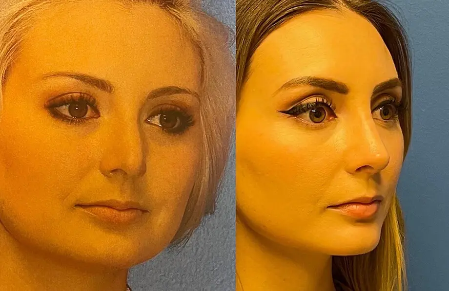 Revision Rhinoplasty Before and After Patient 2