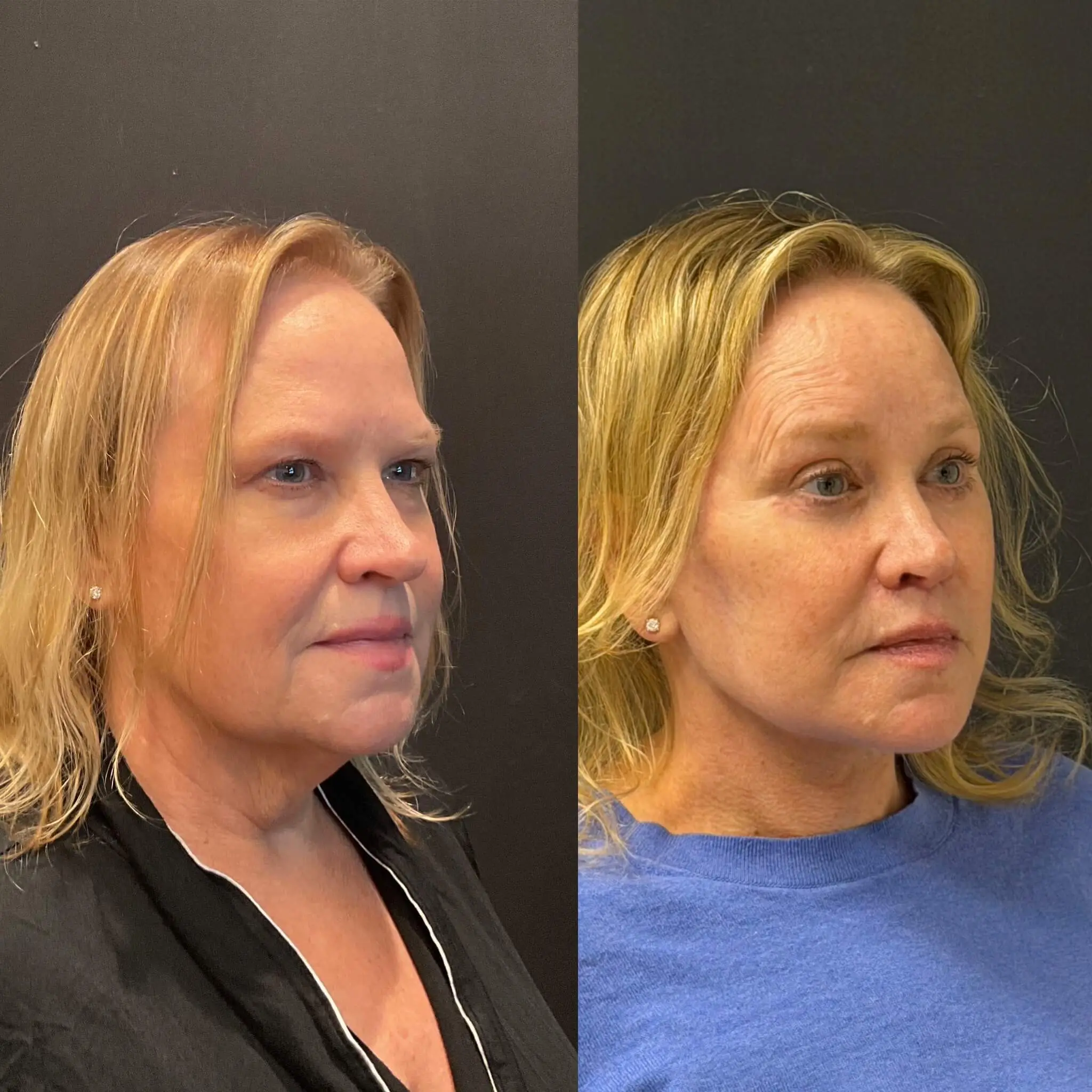 Facelift & Neck Lift Before and After Patient 3