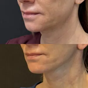 Facelift & Neck Lift Before and After Patient Thumbnail 2