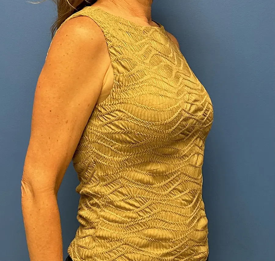Breast Reconstruction Before and After Patient 4