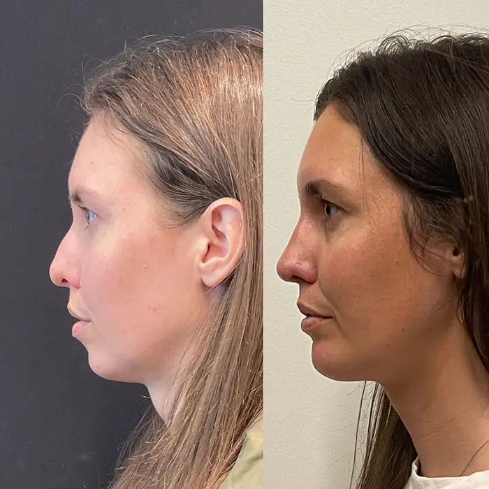 Rhinoplasty Before and After Patient 2