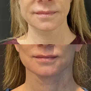 Facelift & Neck Lift Before and After Patient Thumbnail 1