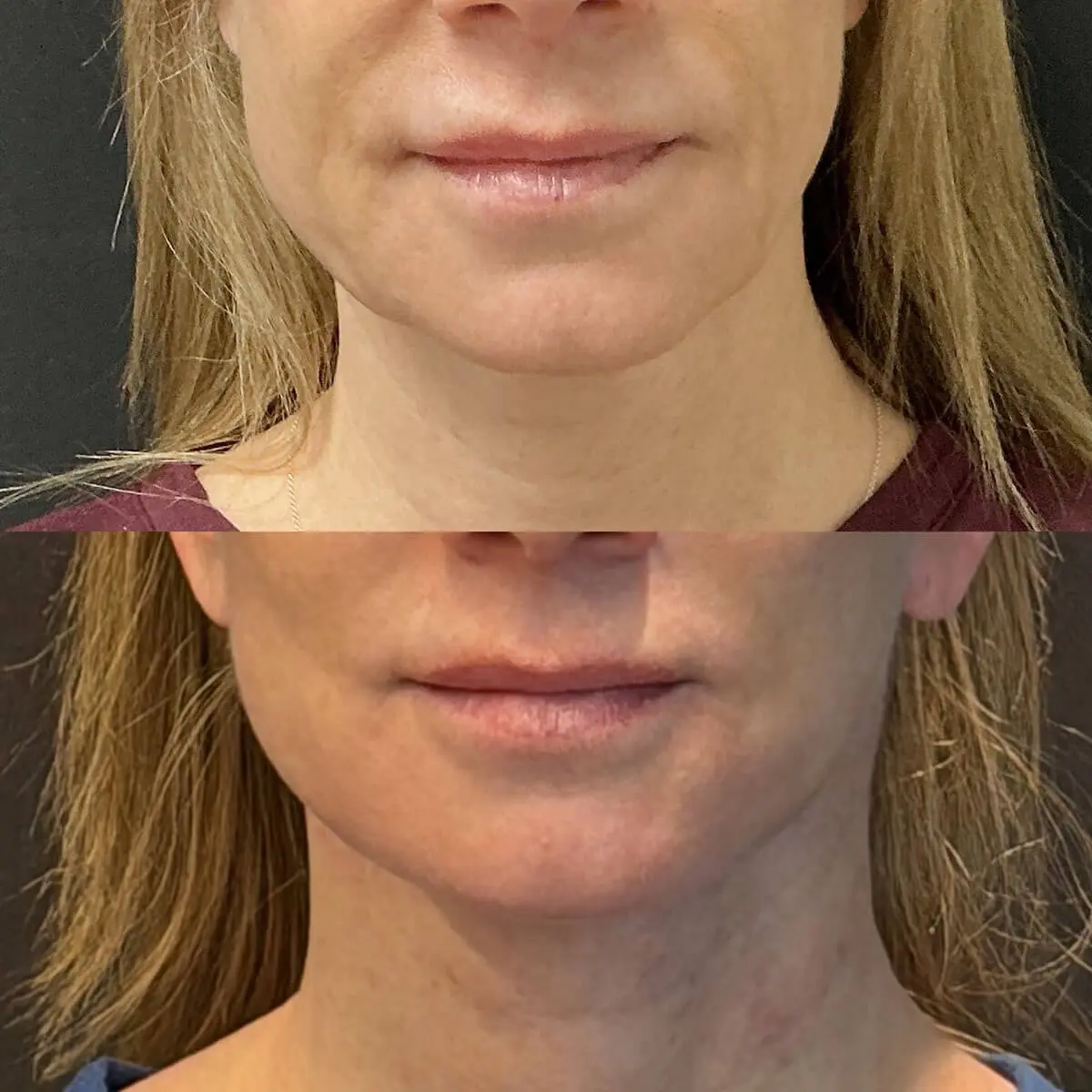 Facelift & Neck Lift Before and After Patient 1