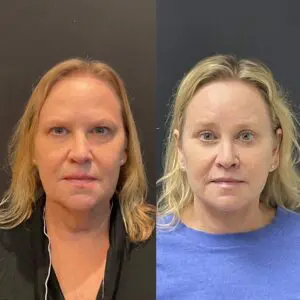 Facelift & Neck Lift Before and After Patient Thumbnail 1