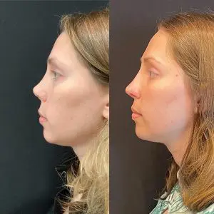 Revision Rhinoplasty Before and After Patient Thumbnail 1