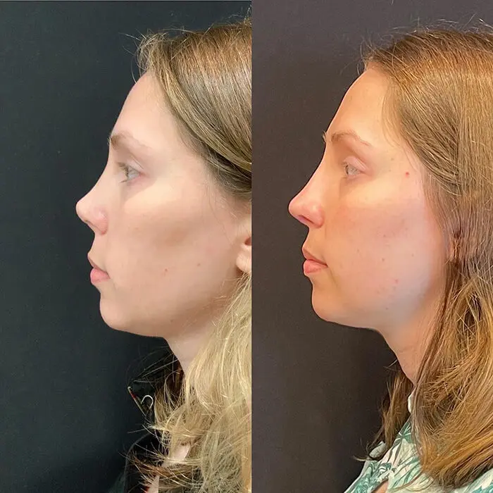 Revision Rhinoplasty Before and After Patient 1