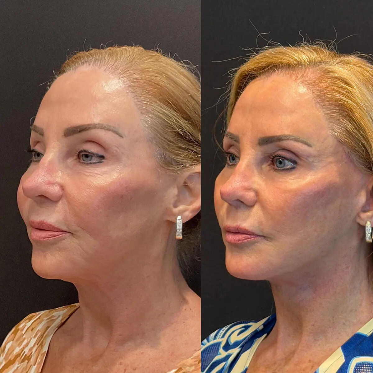 Facelift & Neck Lift Before and After Patient 2