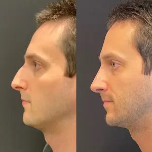 Rhinoplasty Before and After Patient Thumbnail 1