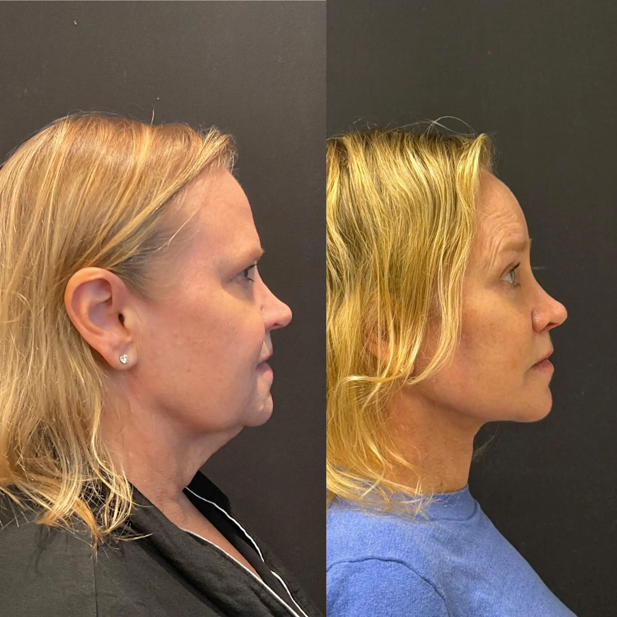 Facelift & Neck Lift Before and After Patient 2
