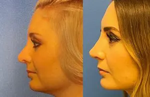 Revision Rhinoplasty Before and After Patient Thumbnail 4