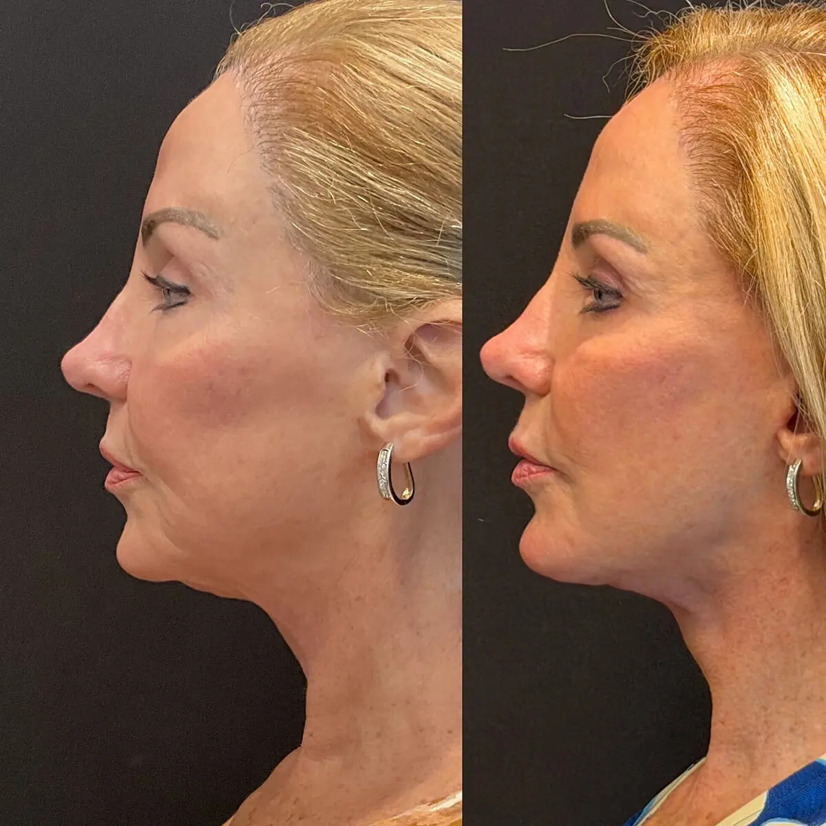 Facelift & Neck Lift Before and After Patient 3