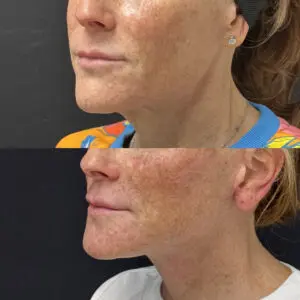 Facelift & Neck Lift Before and After Patient Thumbnail 2