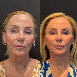 Facelift & Neck Lift Before and After Patient Thumbnail 1