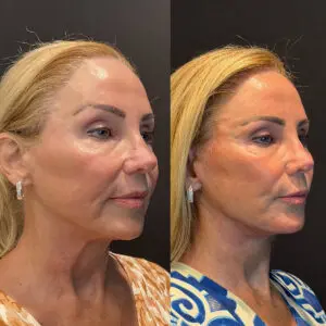 Facelift & Neck Lift Before and After Patient Thumbnail 4