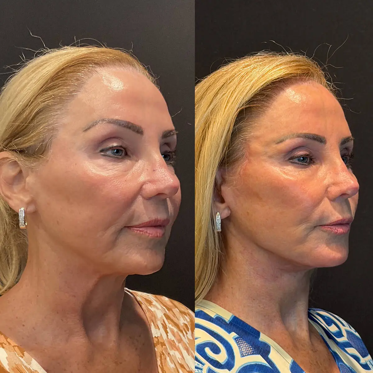 Facelift & Neck Lift Before and After Patient 4