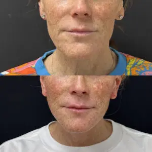 Facelift & Neck Lift Before and After Patient Thumbnail 1