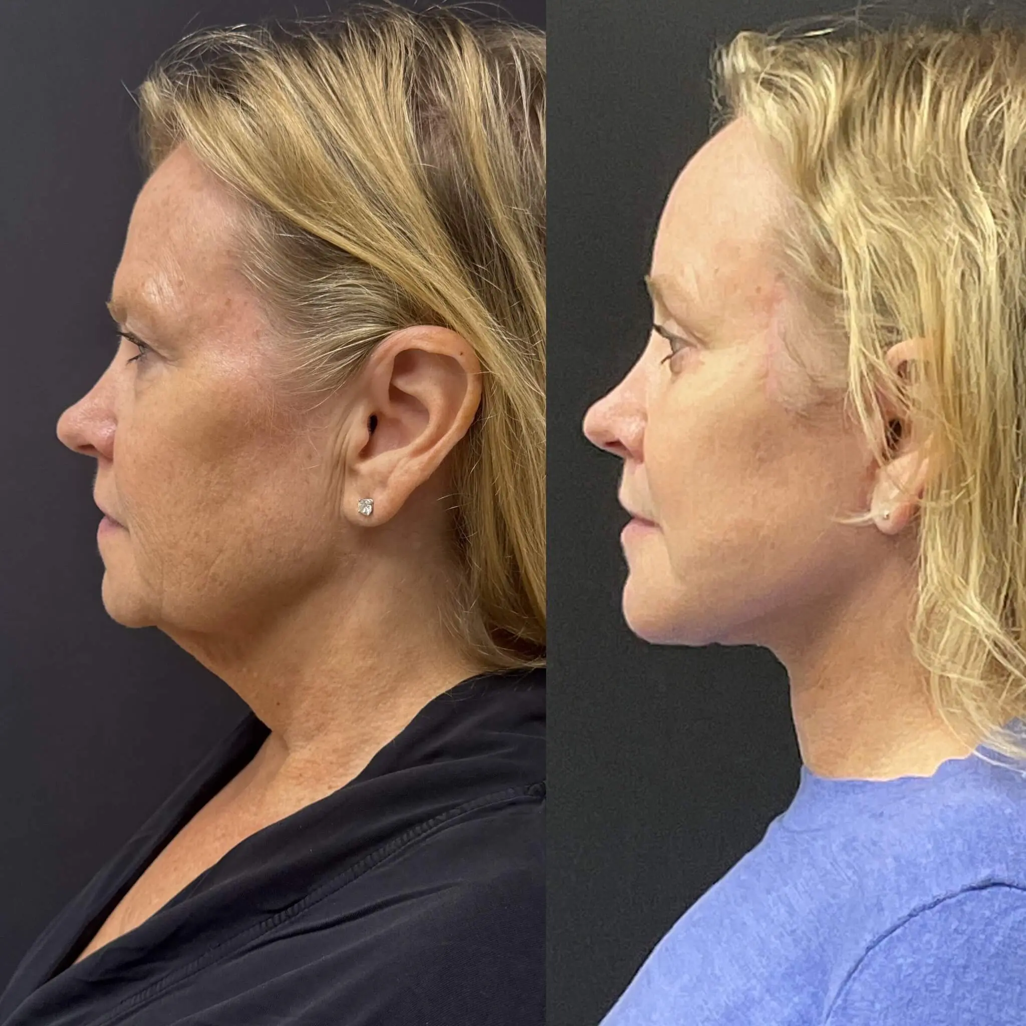 Facelift & Neck Lift Before and After Patient 5