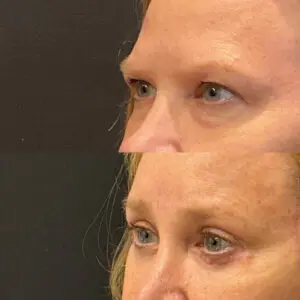 Eyelid Lift Before and After Patient Thumbnail 2