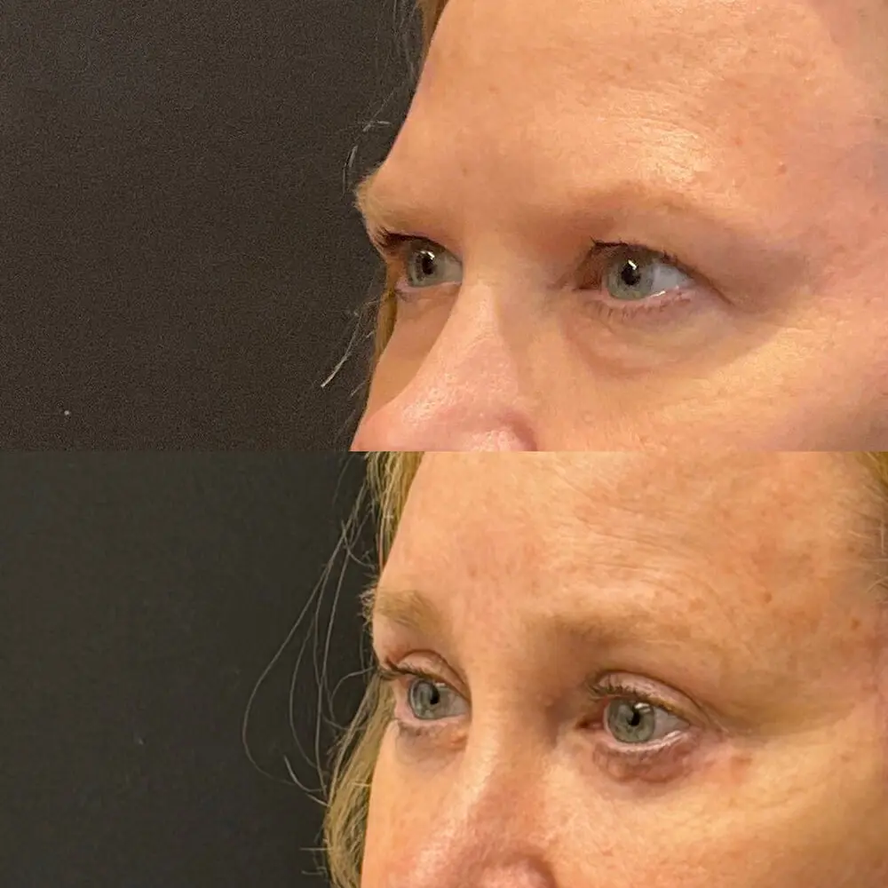 Eyelid Lift Before and After Patient 2