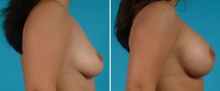 Breast Before and After Patient 4