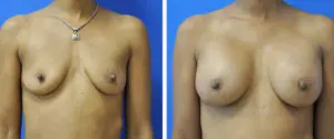Breast Before and After Patient Thumbnail 1