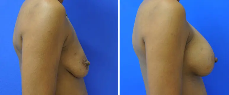 Breast Before and After Patient 3