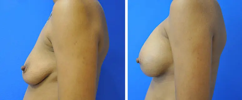 Breast Before and After Patient 4