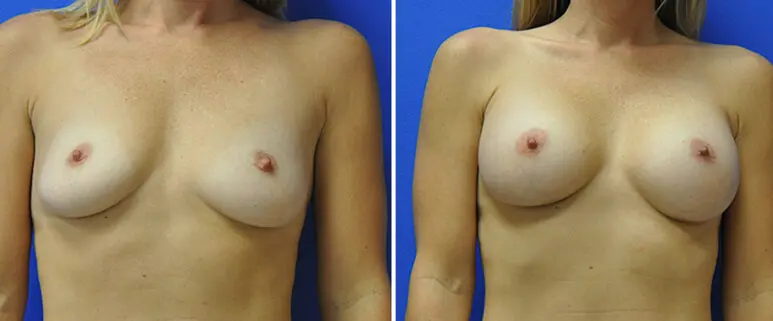 Breast Augmentation Before and After Patient 1