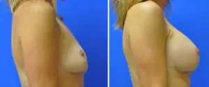 Breast Augmentation Before and After Patient Thumbnail 4