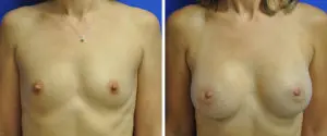 Breast Augmentation Before and After Patient Thumbnail 1
