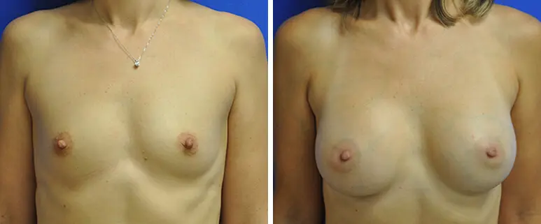 Breast Augmentation Before and After Patient 1