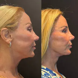 Facelift & Neck Lift Before and After Patient Thumbnail 5
