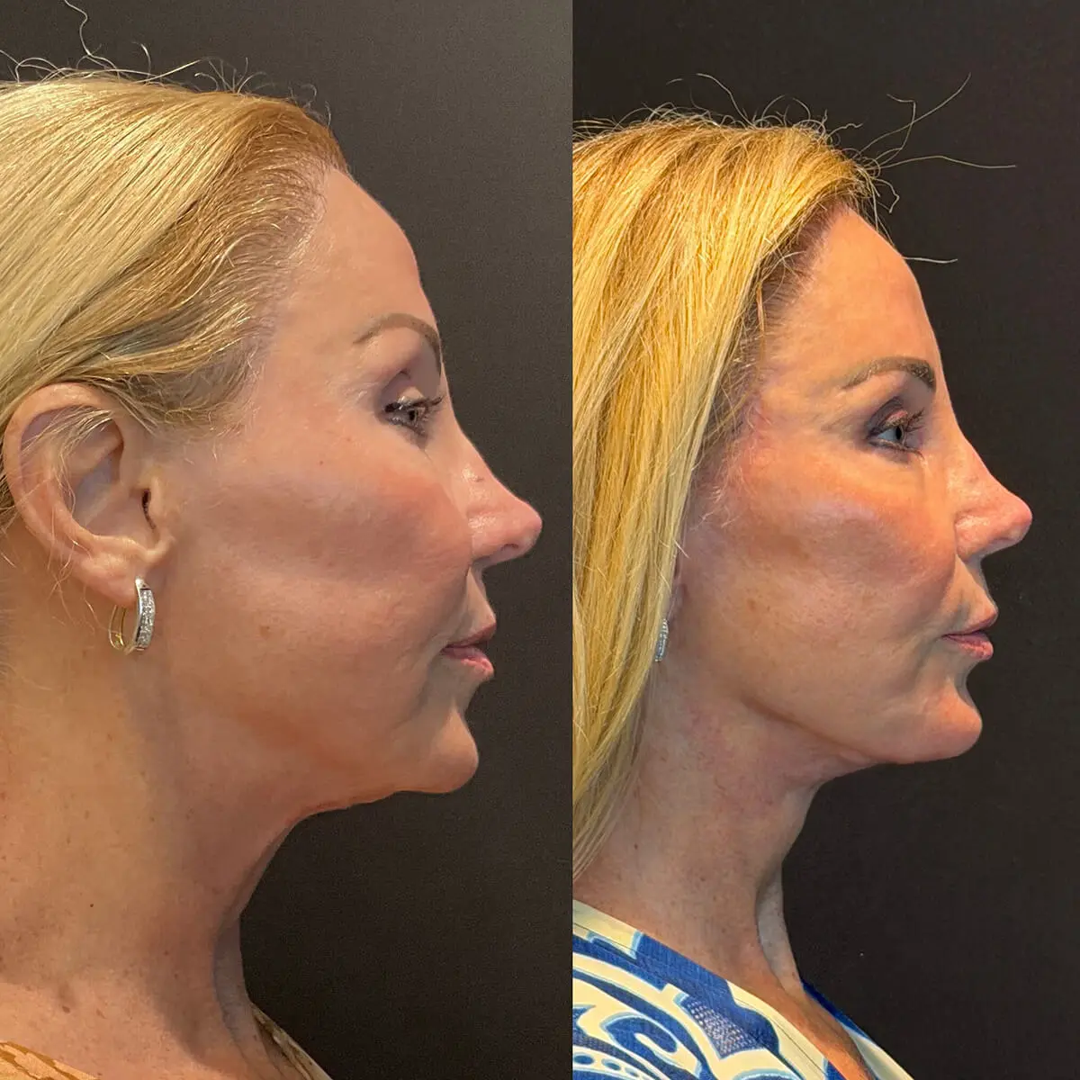 Facelift & Neck Lift Before and After Patient 5