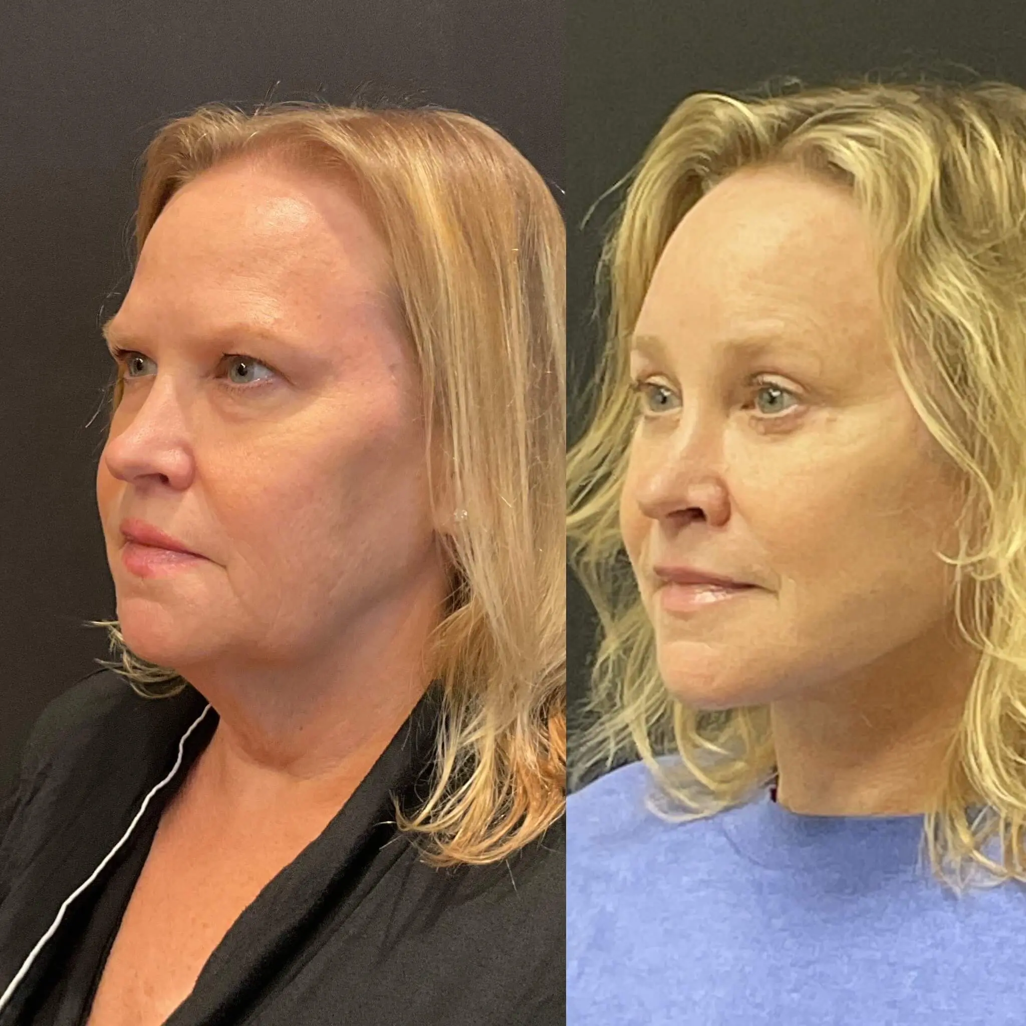 Facelift & Neck Lift Before and After Patient 4