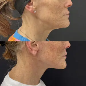 Facelift & Neck Lift Before and After Patient Thumbnail 4