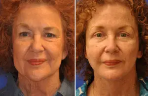 Facelift & Neck Lift Before and After Patient Thumbnail 2