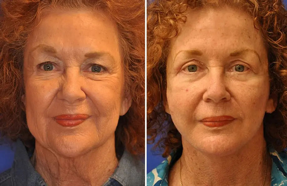 Facelift & Neck Lift Before and After Patient 2