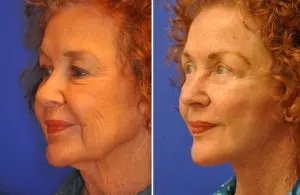 Facelift & Neck Lift Before and After Patient Thumbnail 3