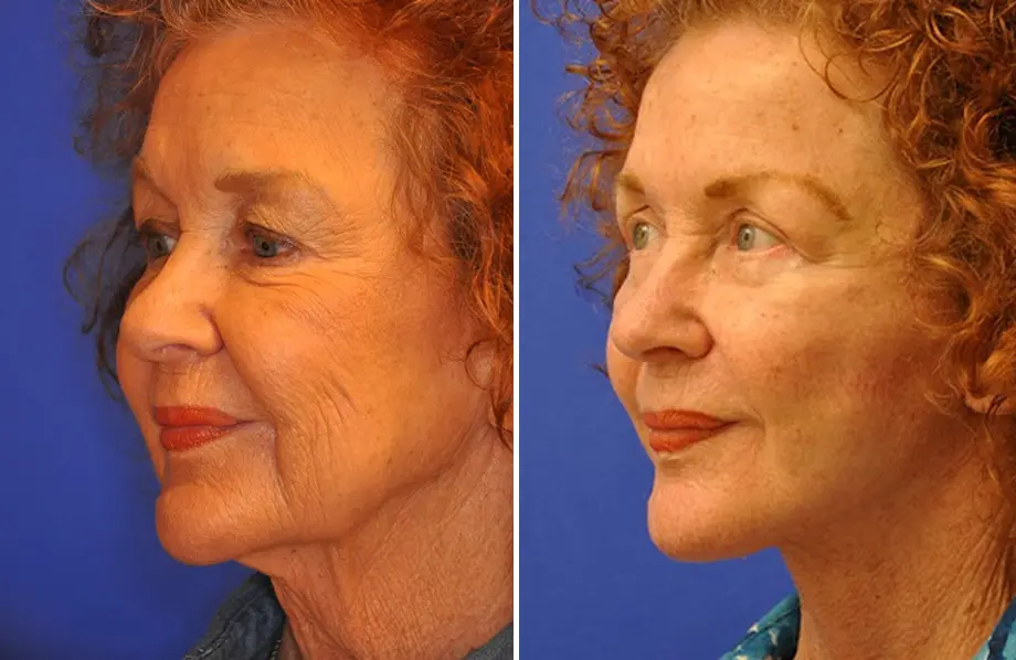 Facelift & Neck Lift Before and After Patient 3