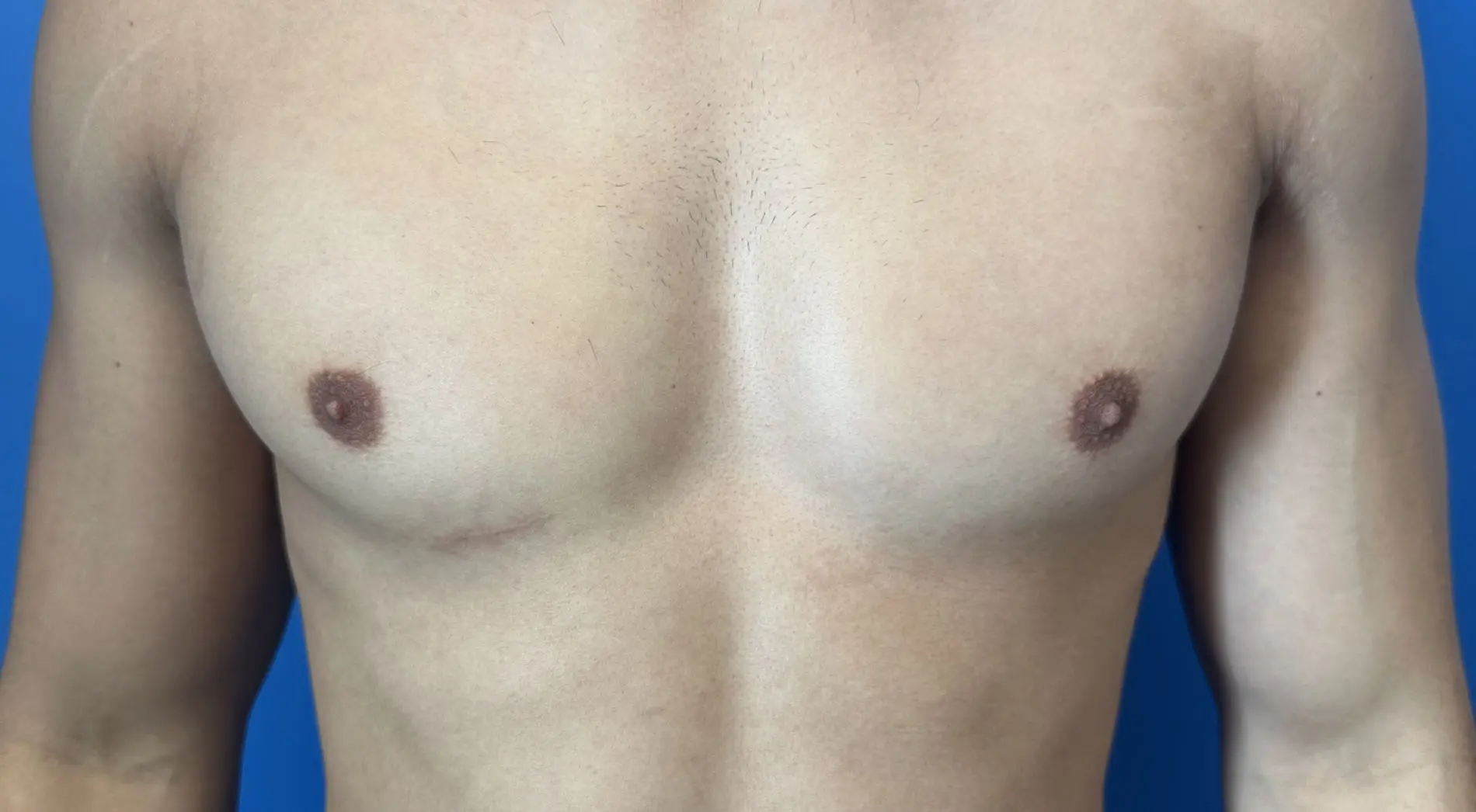 Revision Rhinoplasty Before and After Patient 1