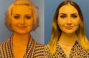 Revision Rhinoplasty Before and After Patient Thumbnail 5