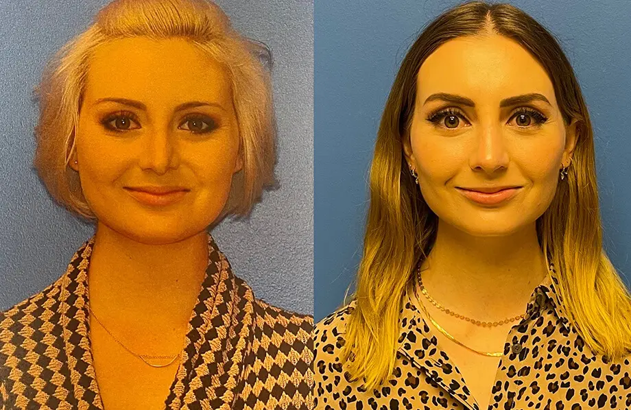 Revision Rhinoplasty Before and After Patient 5