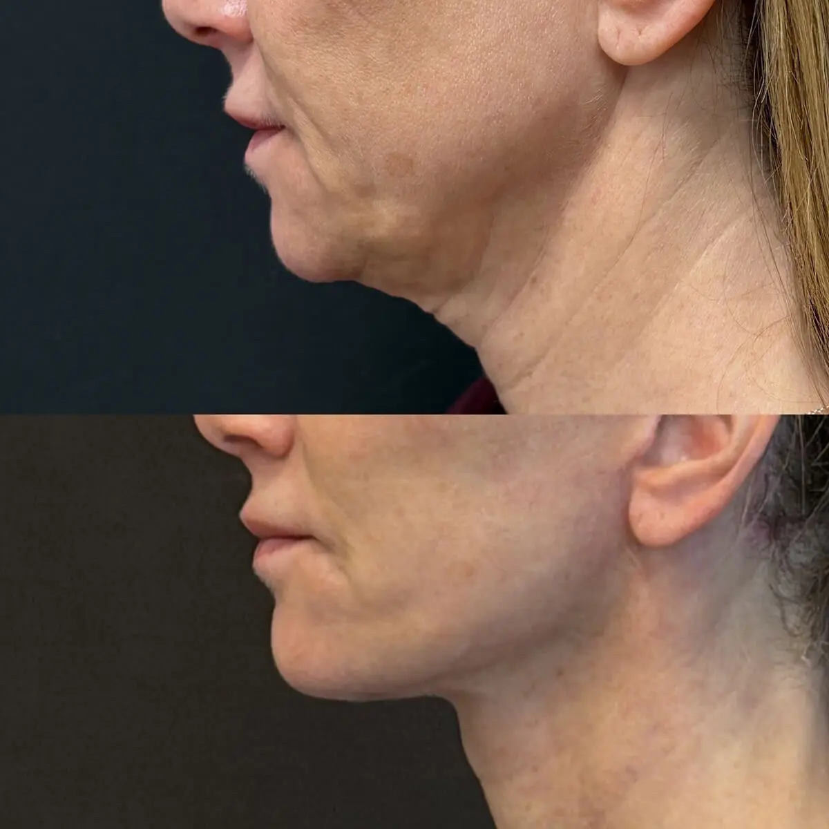 Facelift & Neck Lift Before and After Patient 4