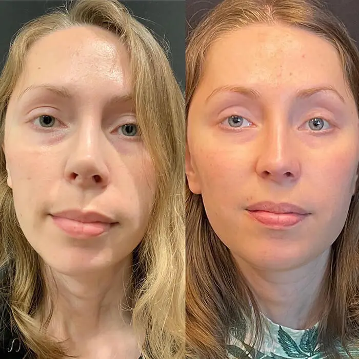 Revision Rhinoplasty Before and After Patient 3