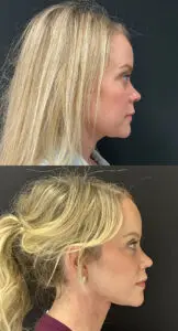 Facial Rejuvenation Before and After Patient Thumbnail 5